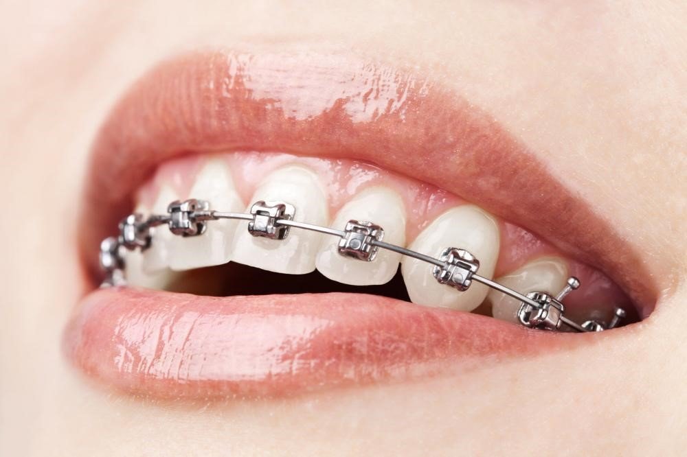 Orthodontics Las Vegas